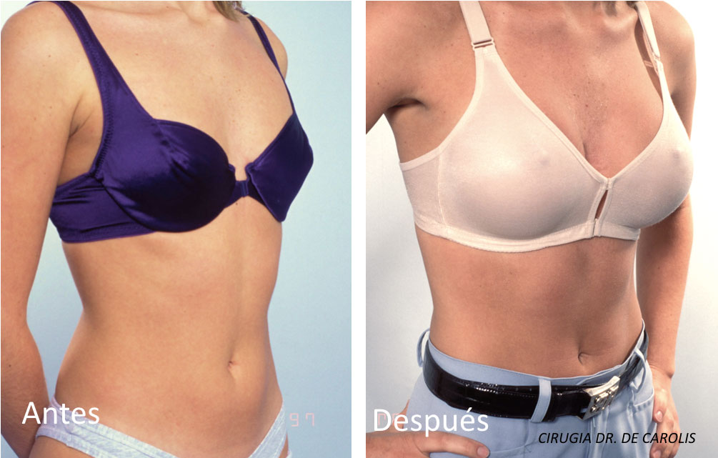  imagen-implantes-mamarios