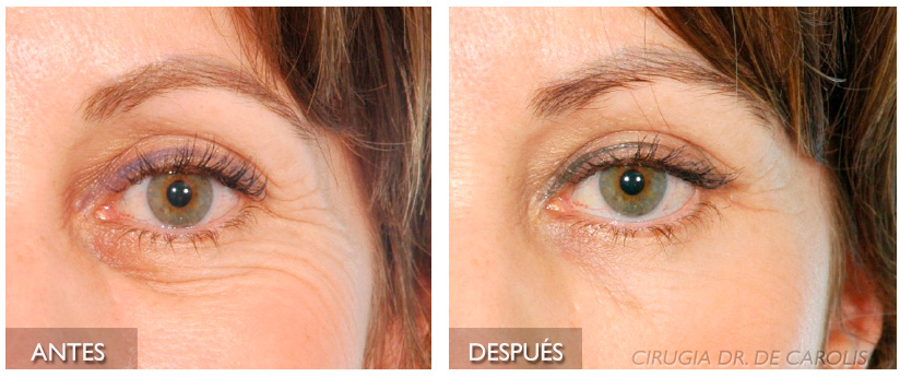 imagen-Lipoinjerto-facial-natural