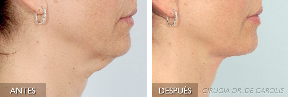 imagen-minilifting-de-cuello