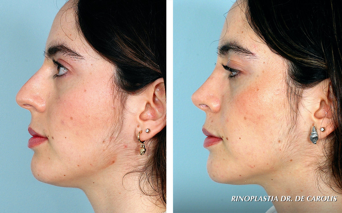 Rinoplastia conservadora con refinamiento de la punta nasal realizada por el Dr. Vicente De Carolis. Vista de perfil.