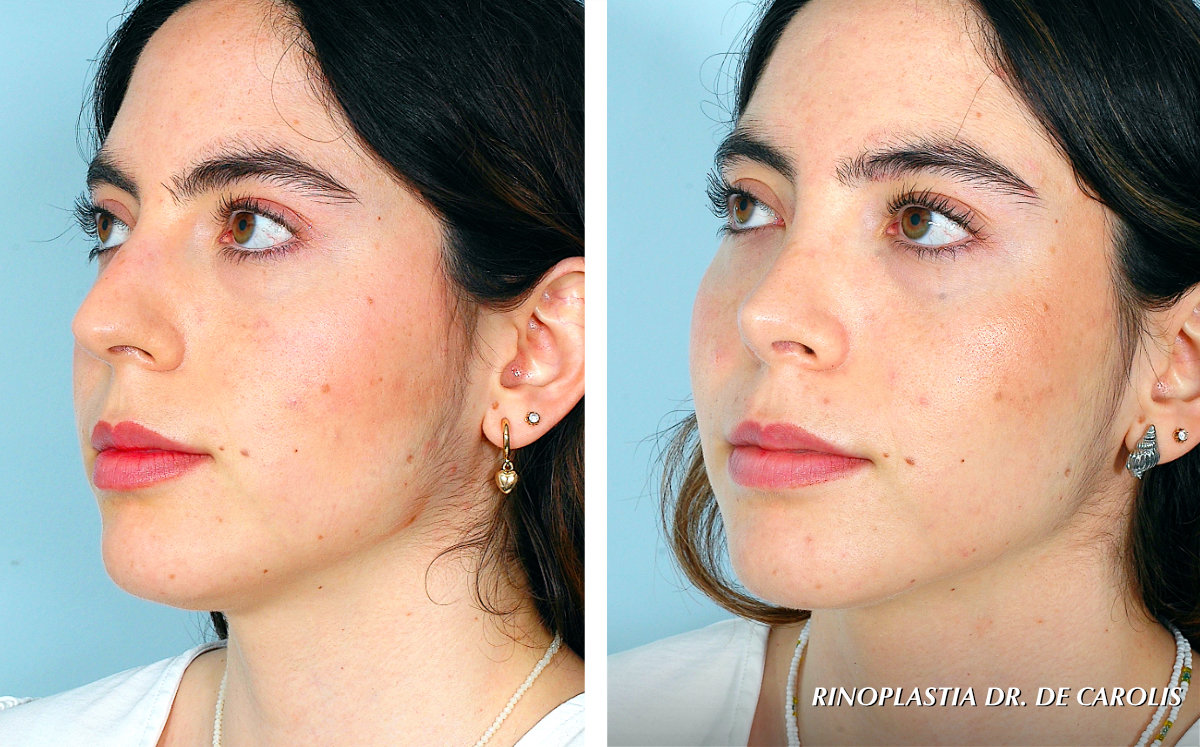 Rinoplastia conservadora con refinamiento de la punta nasal  realizada por el Dr. Vicente De Carolis. Vista de semiperfil.