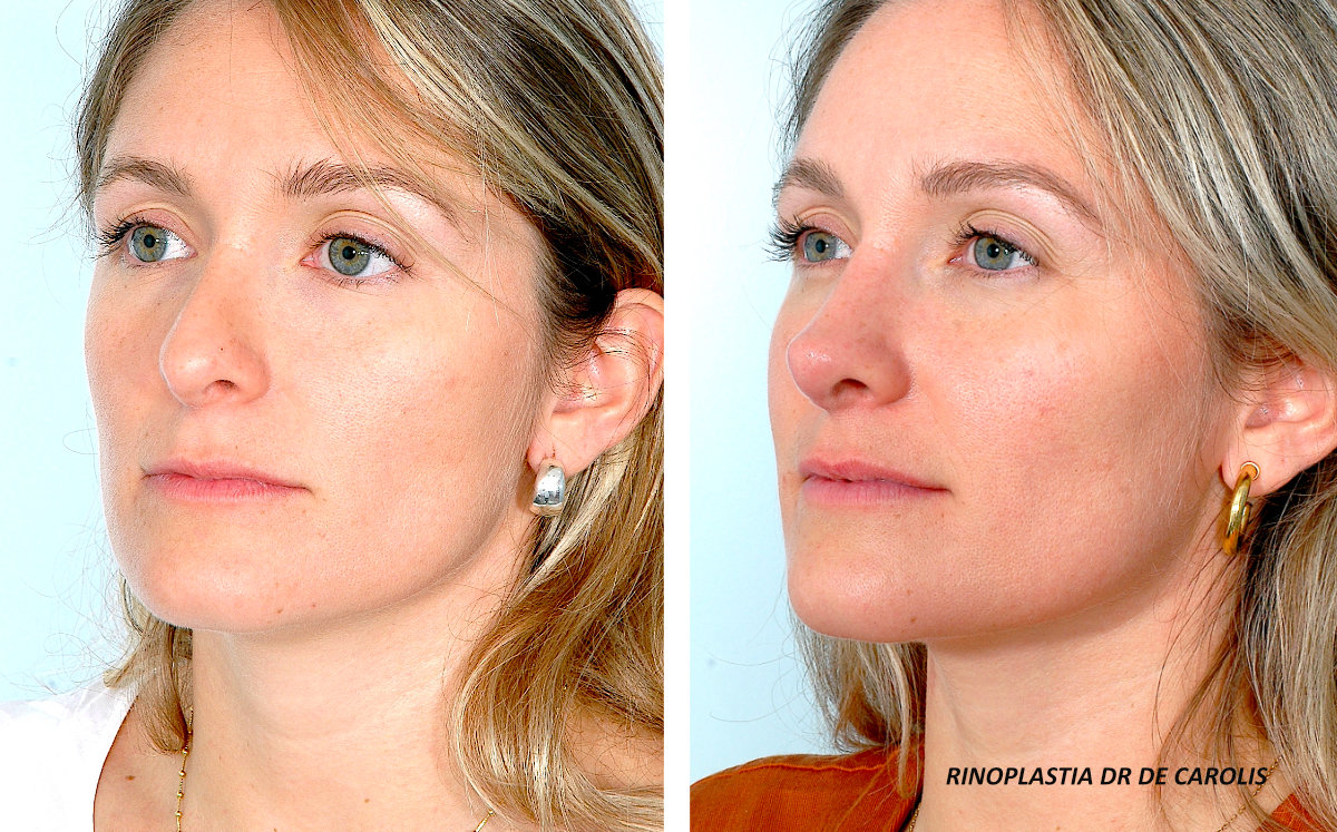 Rinoplastia secundaria para mejorar la armonía facial por el Dr. De Carolis. Vista de semiperfil.